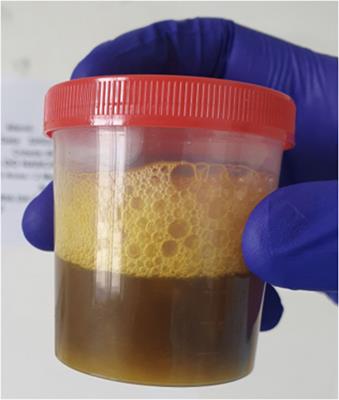 Case report: Biliobronchial fistula after biliary tract stenosis